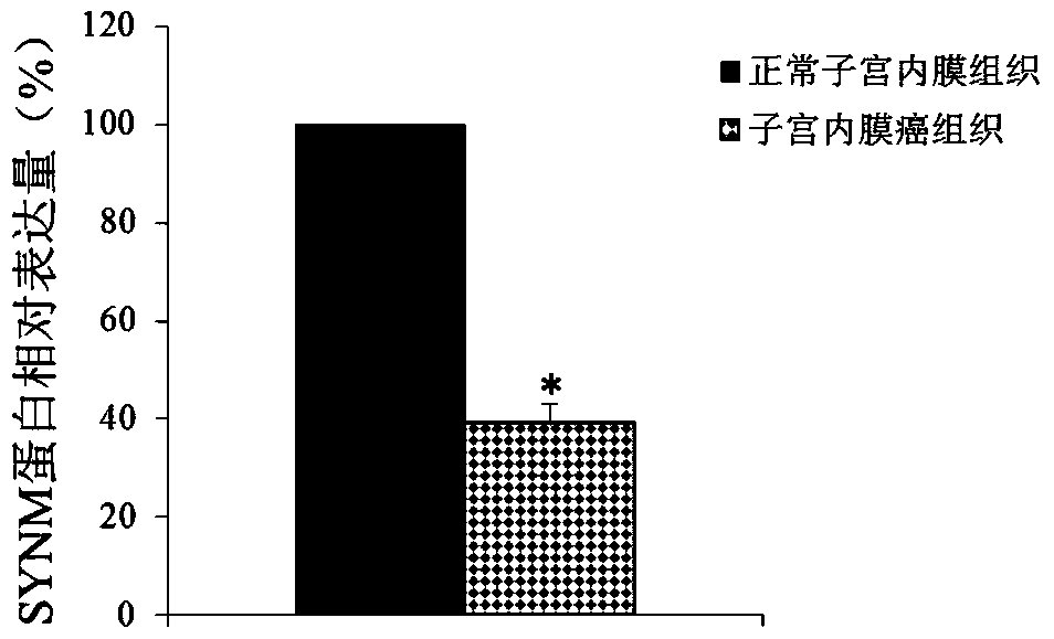 Application of synm in preparation of tools for diagnosing or treating endometrial cancer