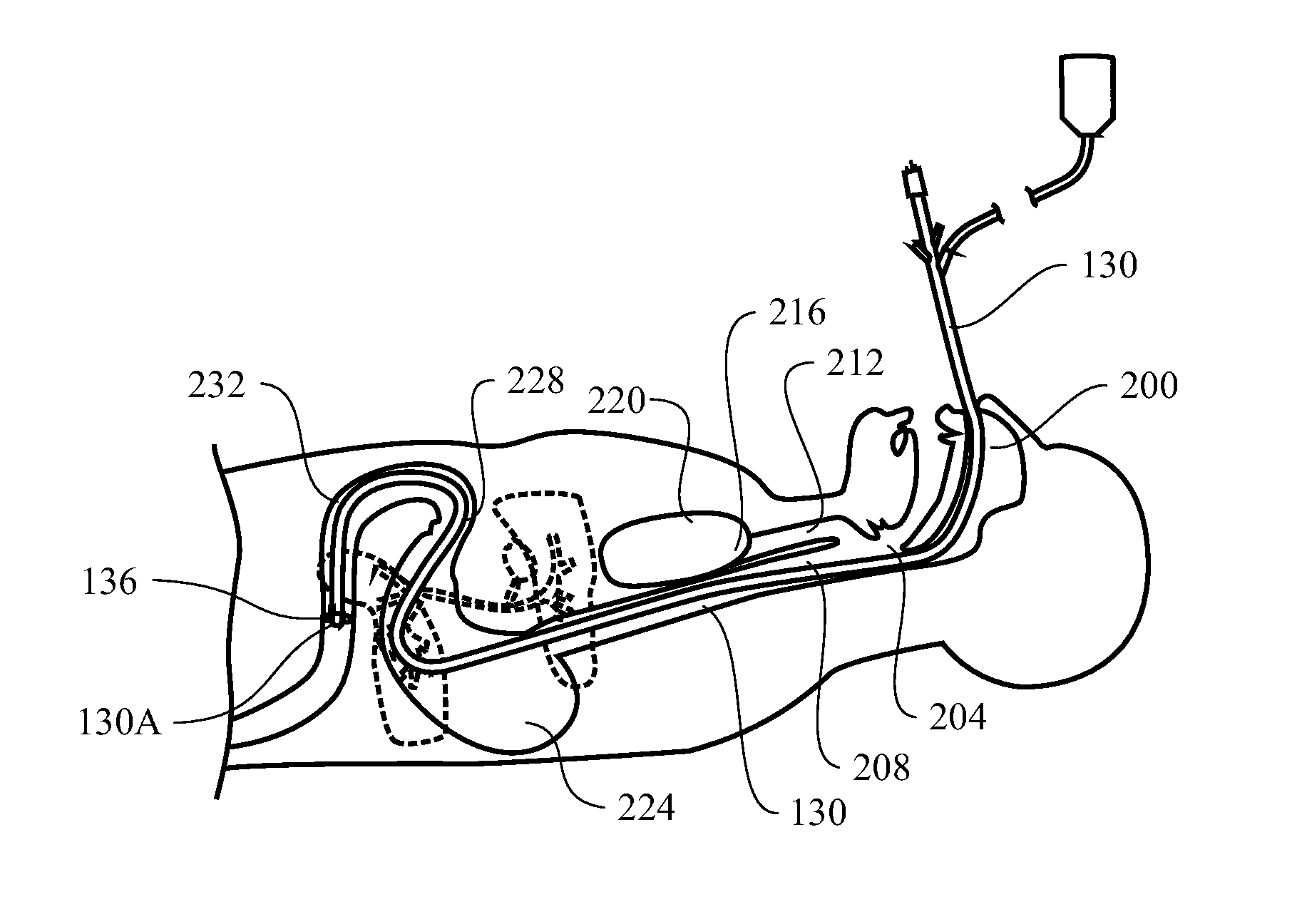 Optically guided medical tube and control unit assembly and methods of use