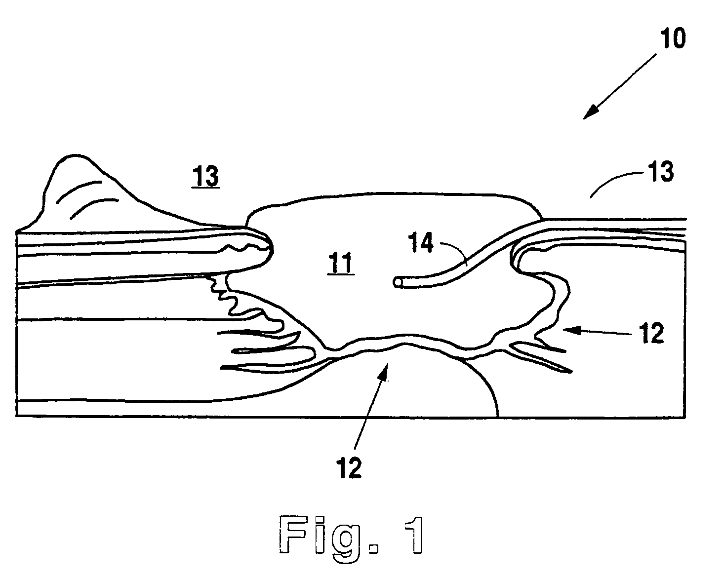 Negative pressure wound therapy system with provision for introduction of an agent