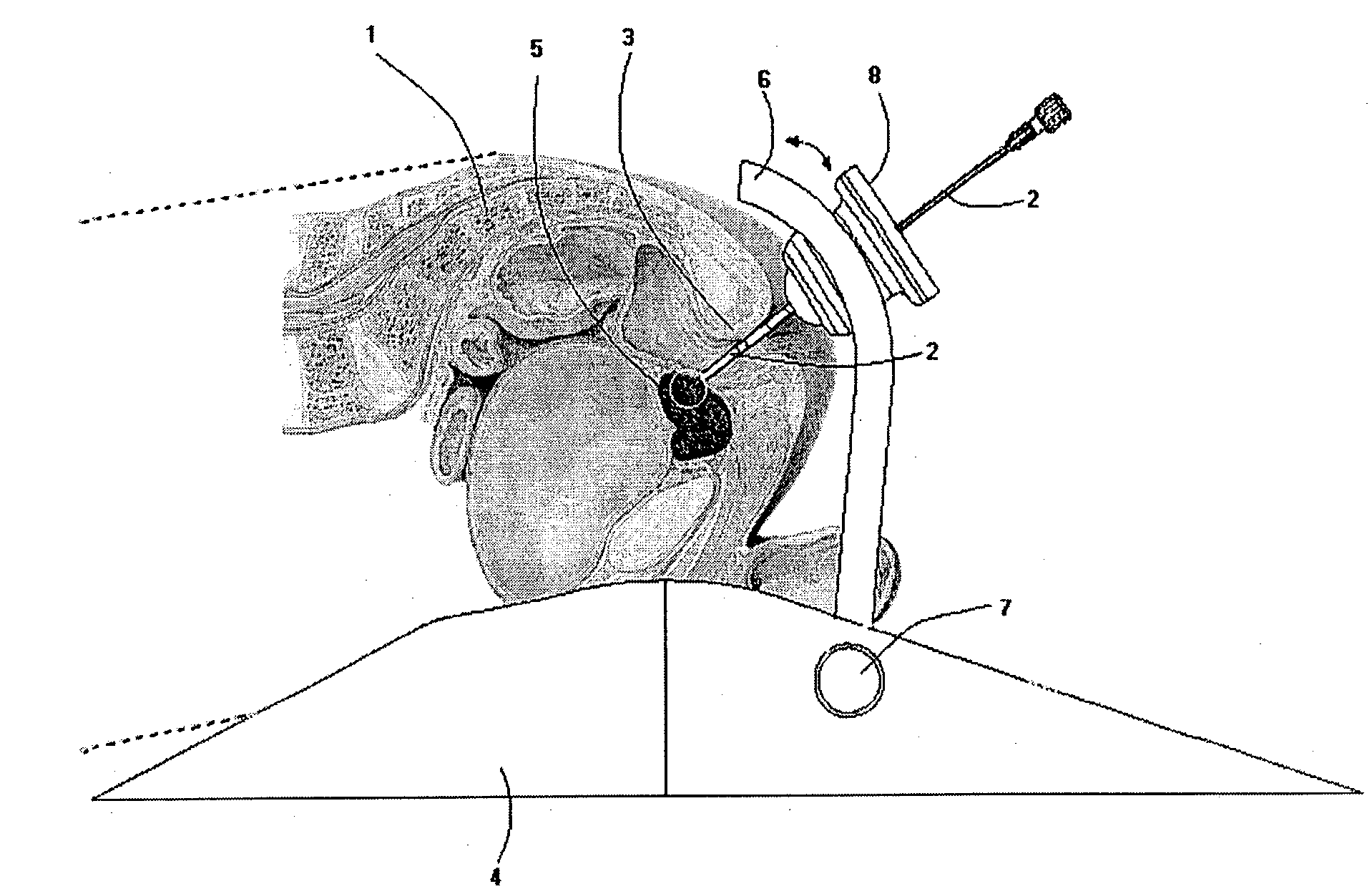 Method and apparatus for MR-guided biopsy