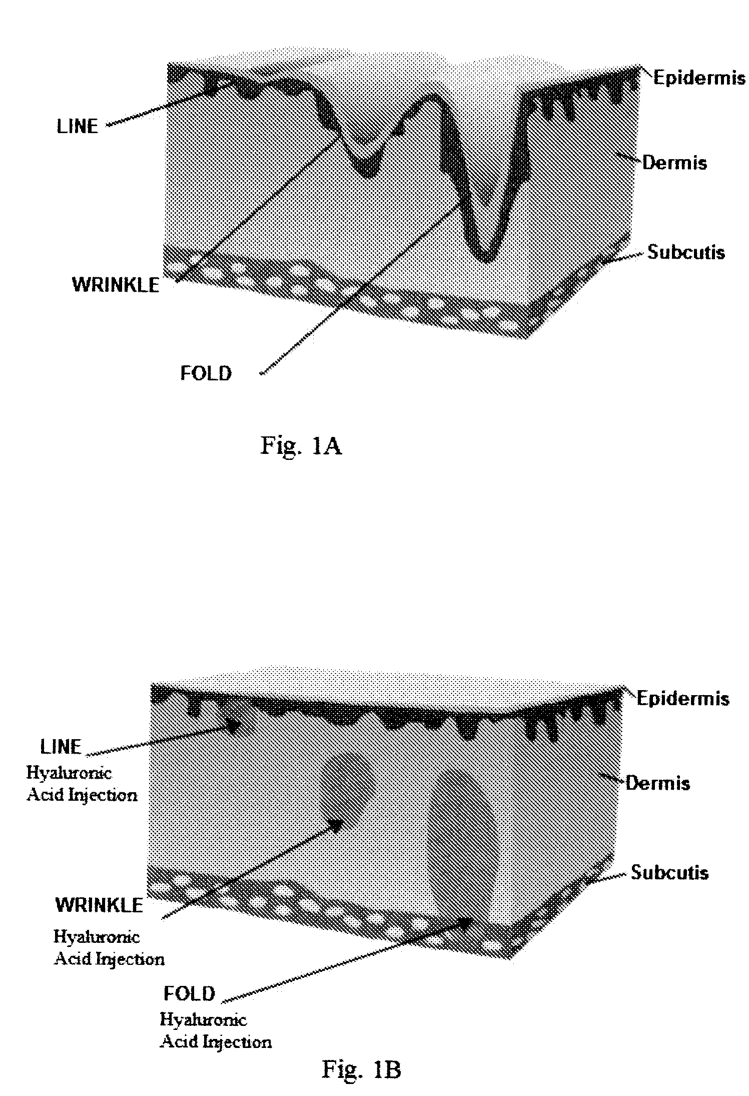 Coated Hyaluronic Acid Particles