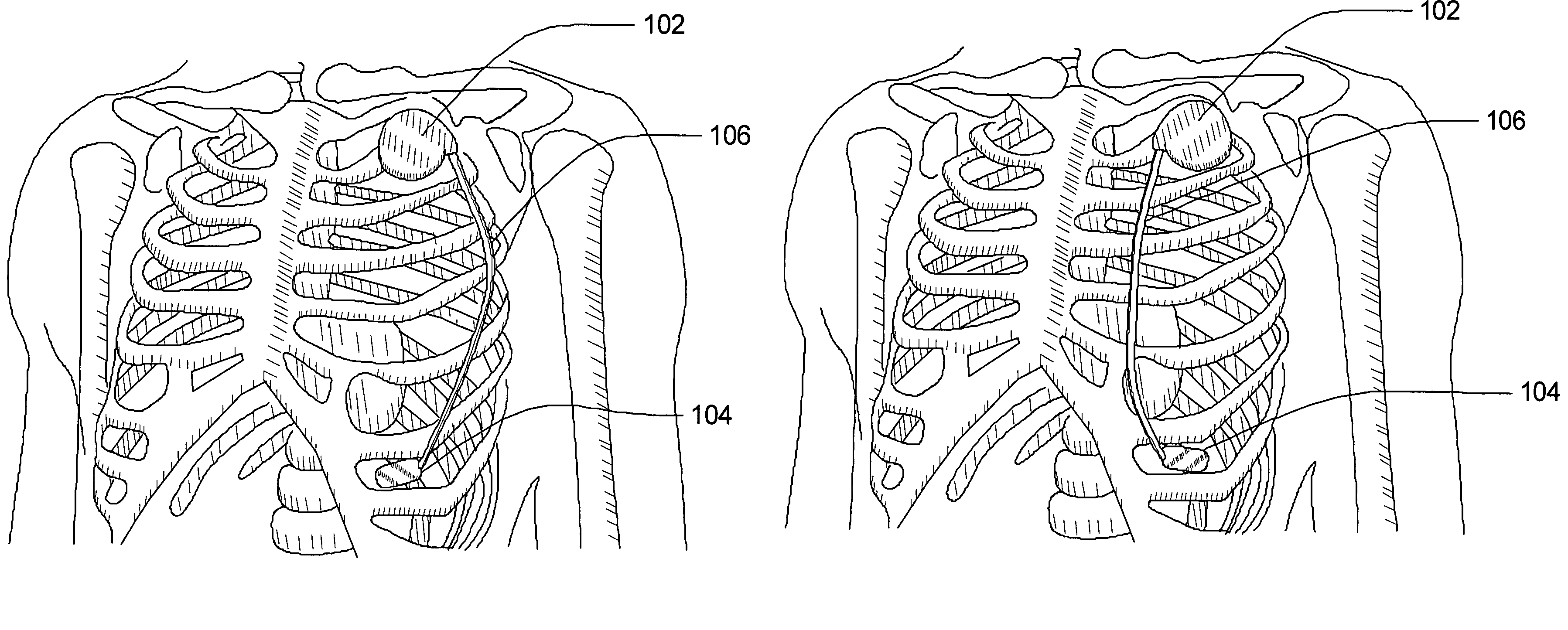 Multi-parameter arrhythmia discrimination