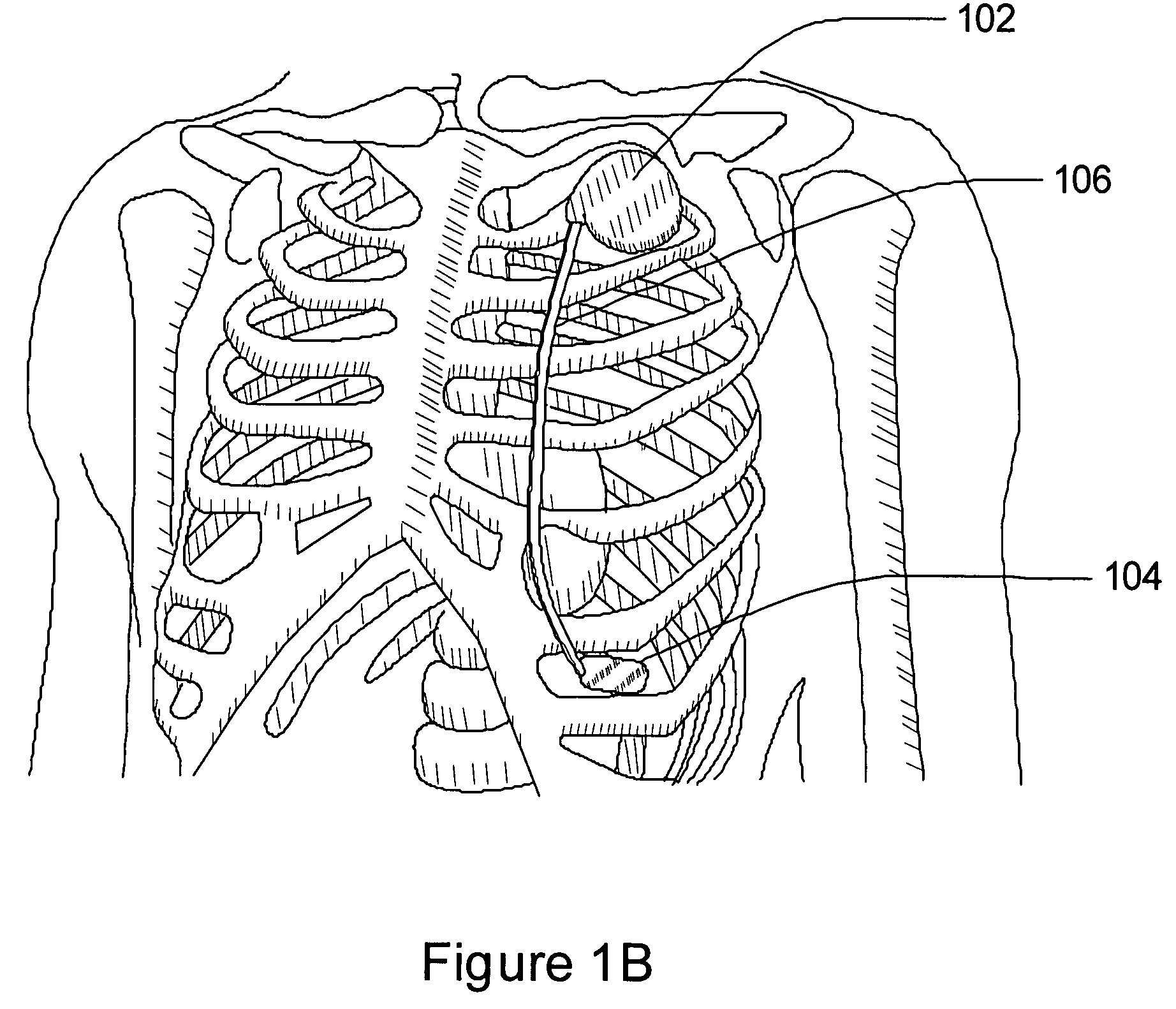 Multi-parameter arrhythmia discrimination