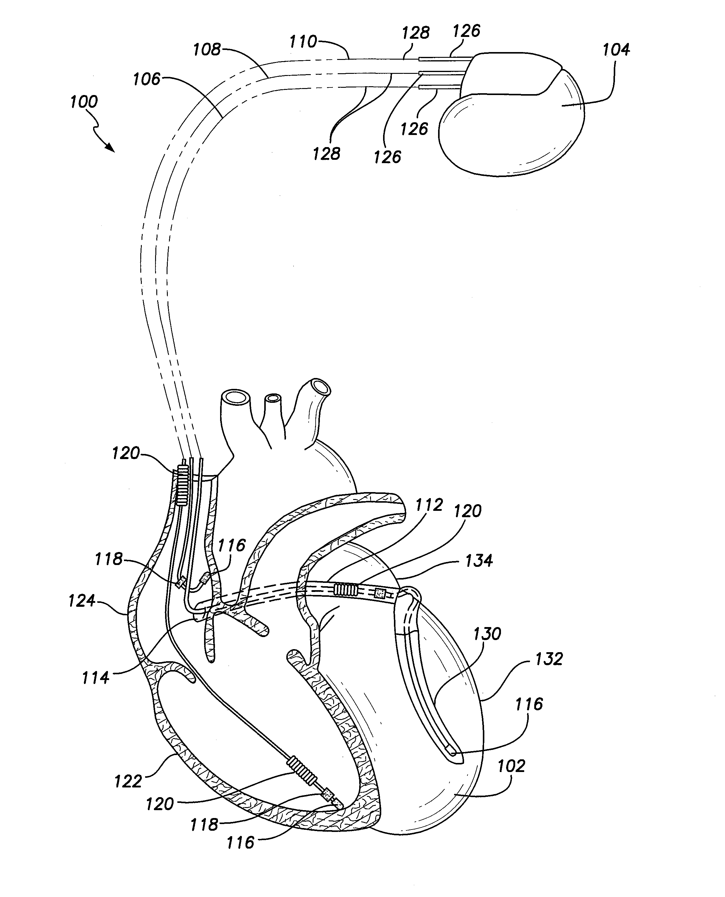 Implantable lead with body profile optimized for implant environment