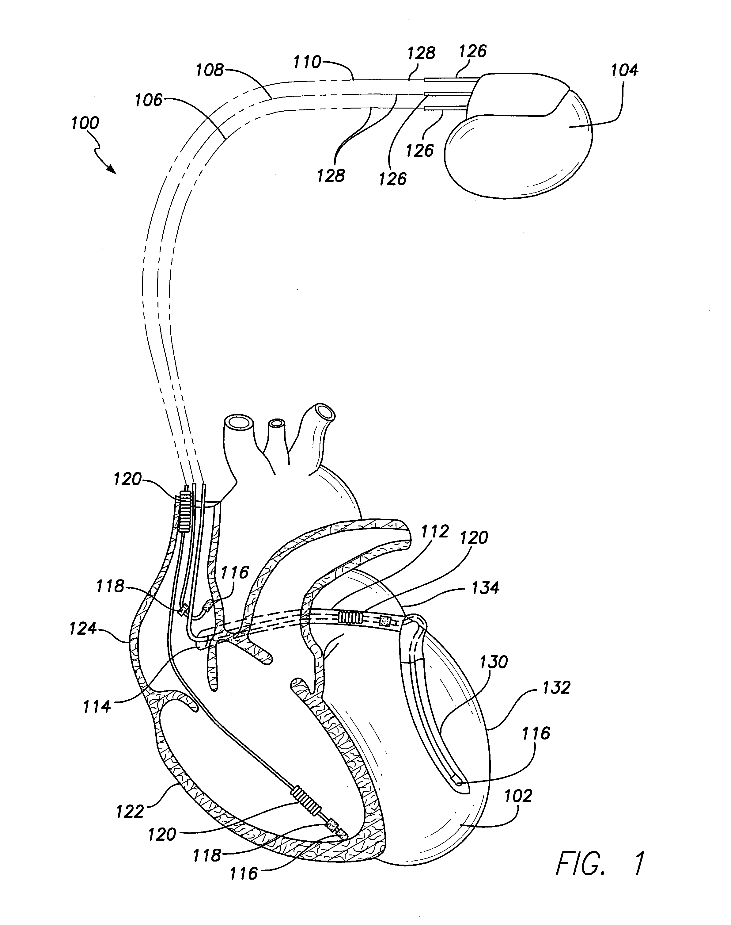 Implantable lead with body profile optimized for implant environment