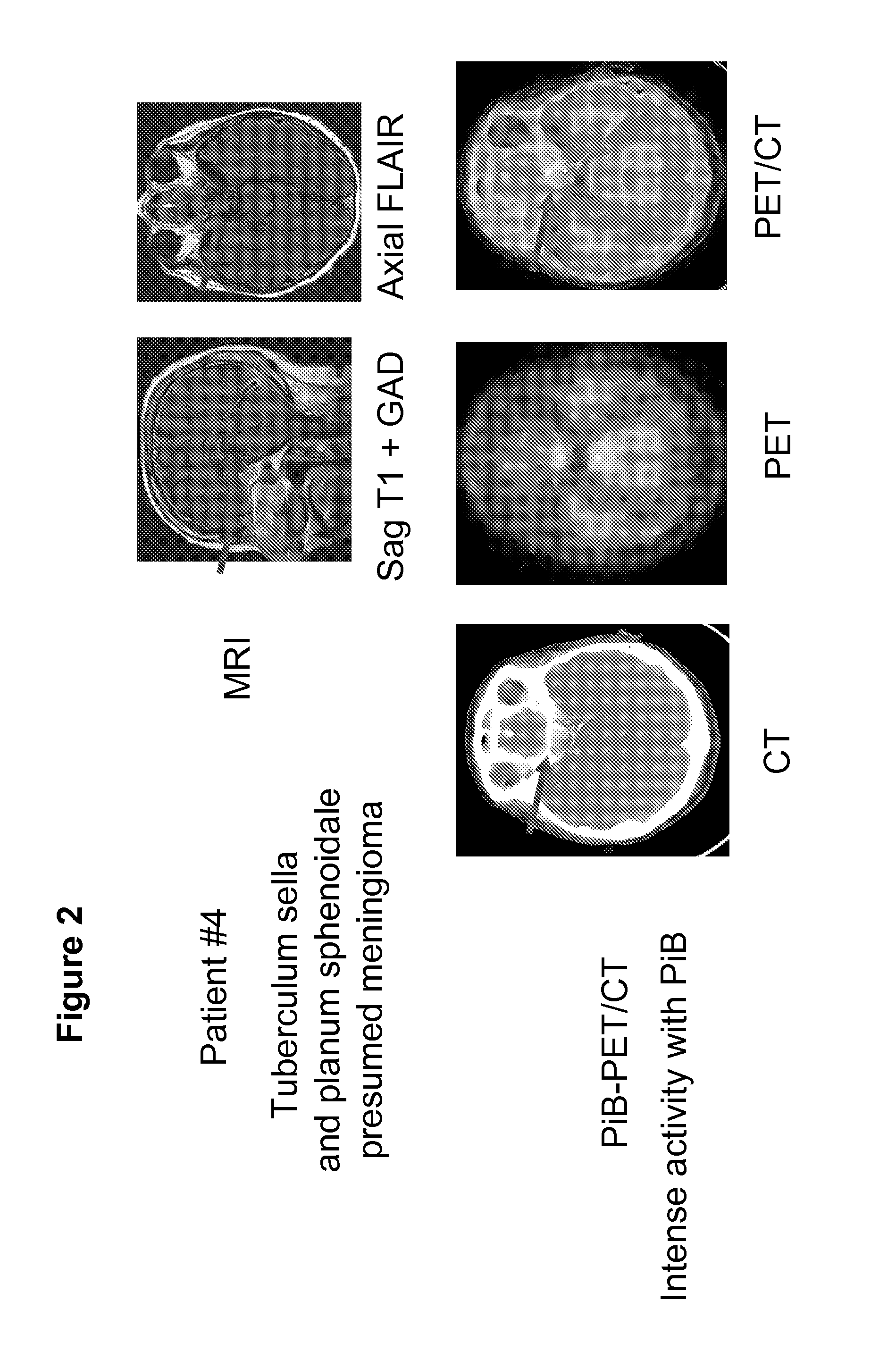 Imaging of meningiomas using phenylbenzothiazole, stilbene, or biphenylalkyne derivatives