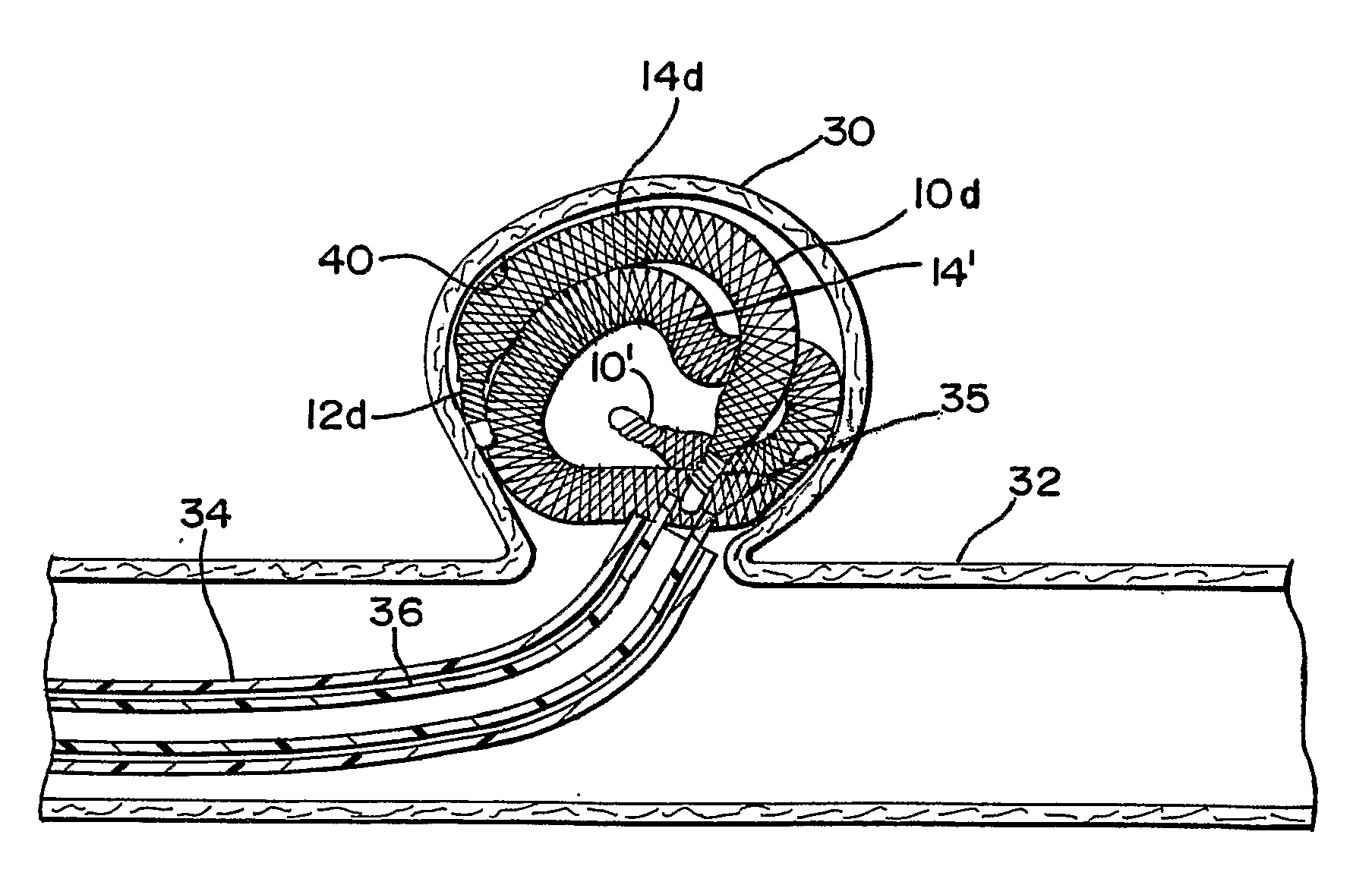 Expandable Vascular Occlusion Device