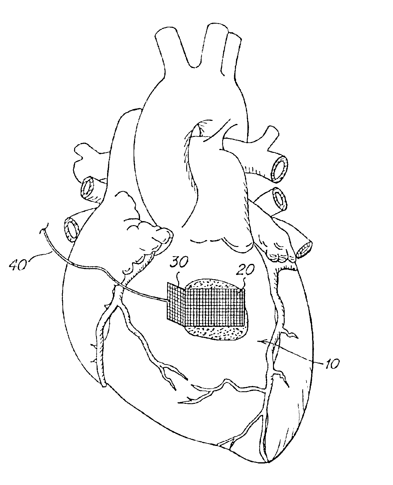 Biodegradable tissue retractor