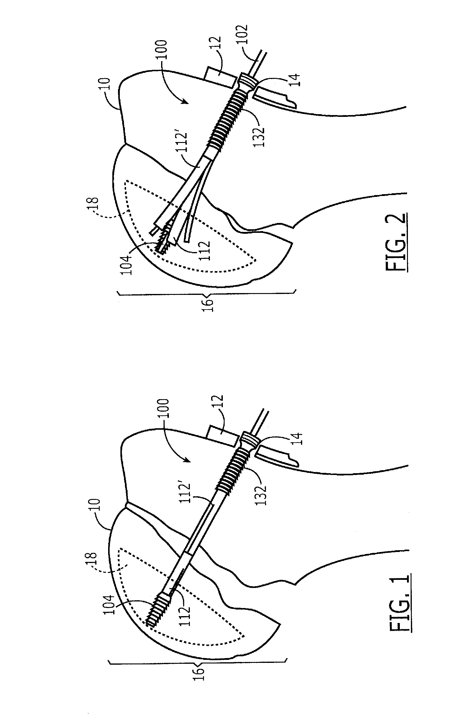 Expandable Bone Support