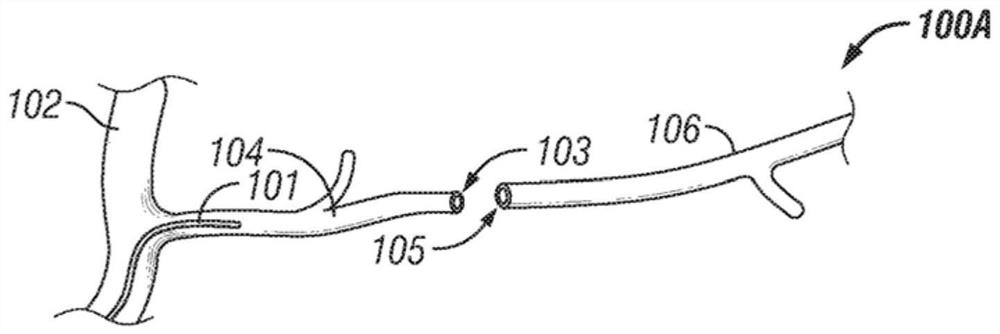 Improved stent delivery for vascular surgery