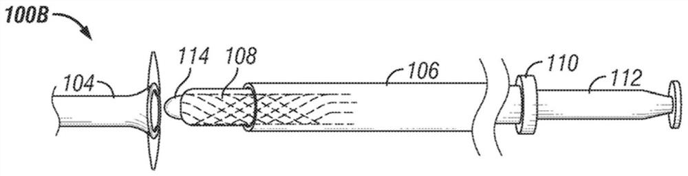 Improved stent delivery for vascular surgery