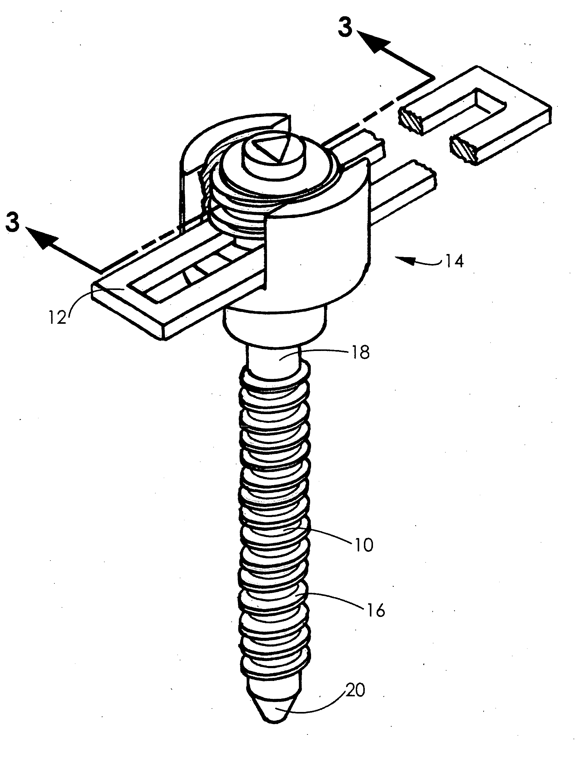 Spinal fixation system