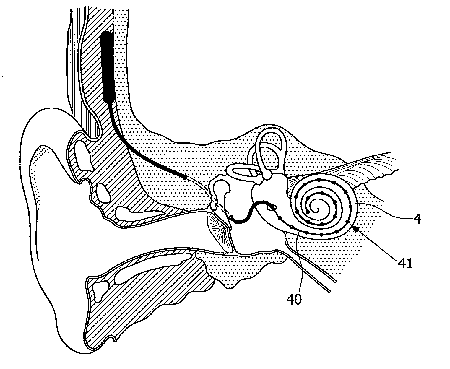 Device and method for improving hearing