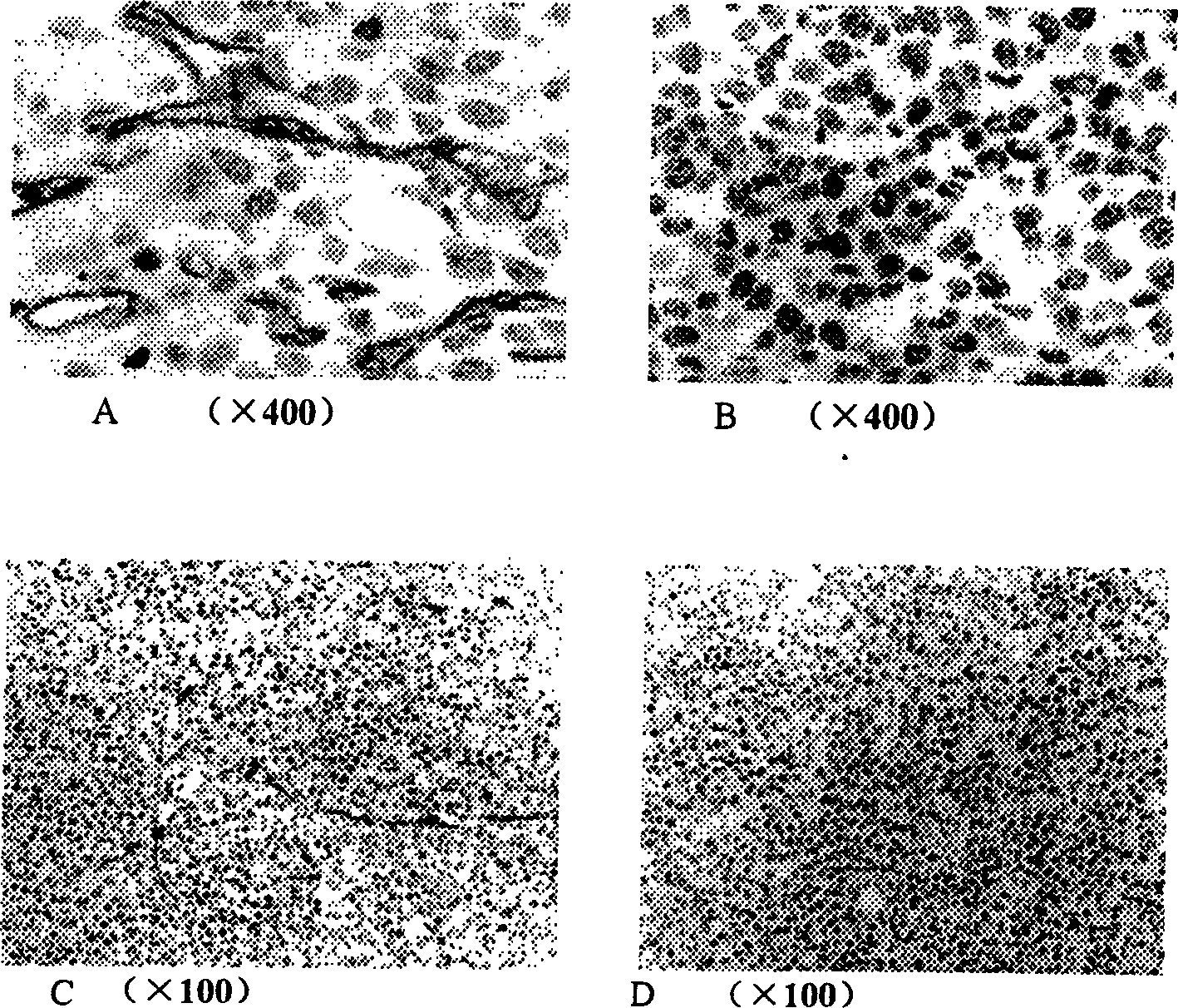 Method of inhibiting neonate tumour blood vessel