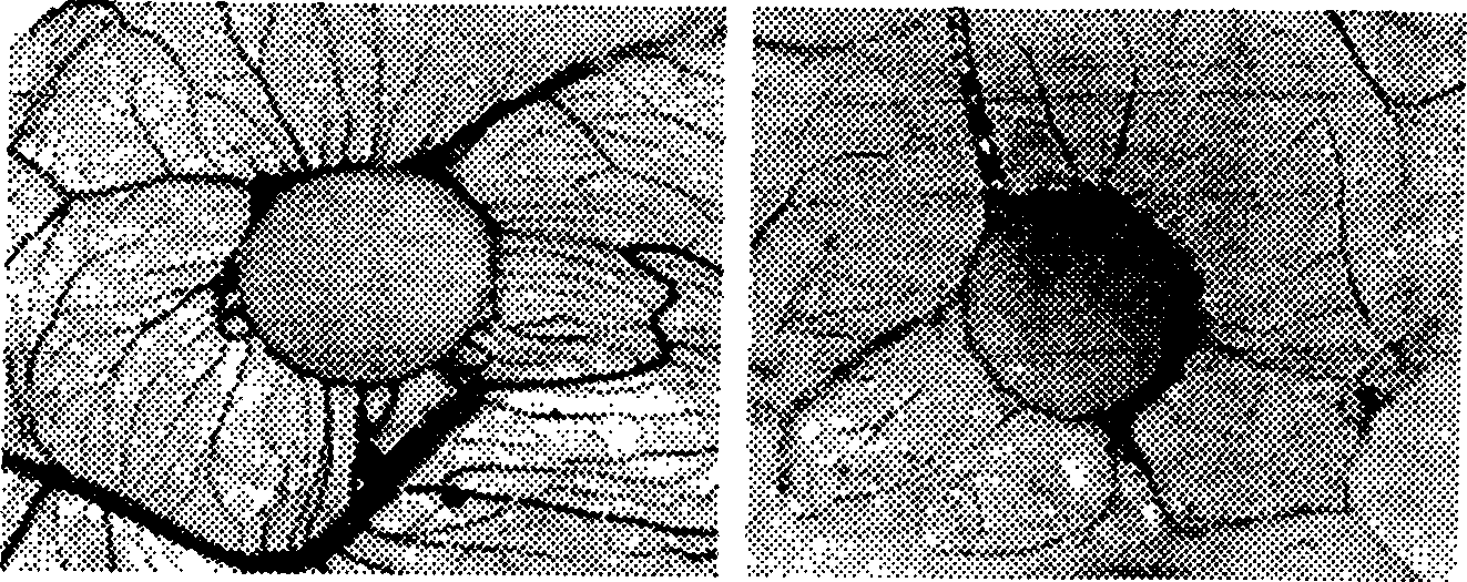 Method of inhibiting neonate tumour blood vessel