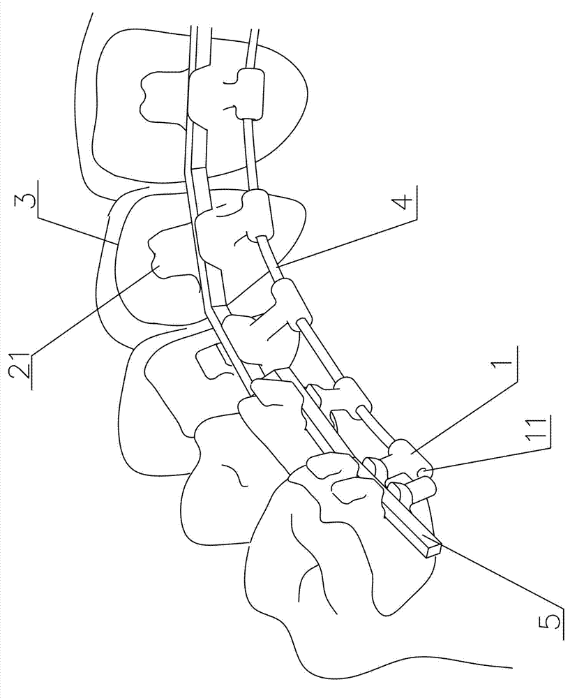 Personalized orthodontic appliance having orthoaxis function