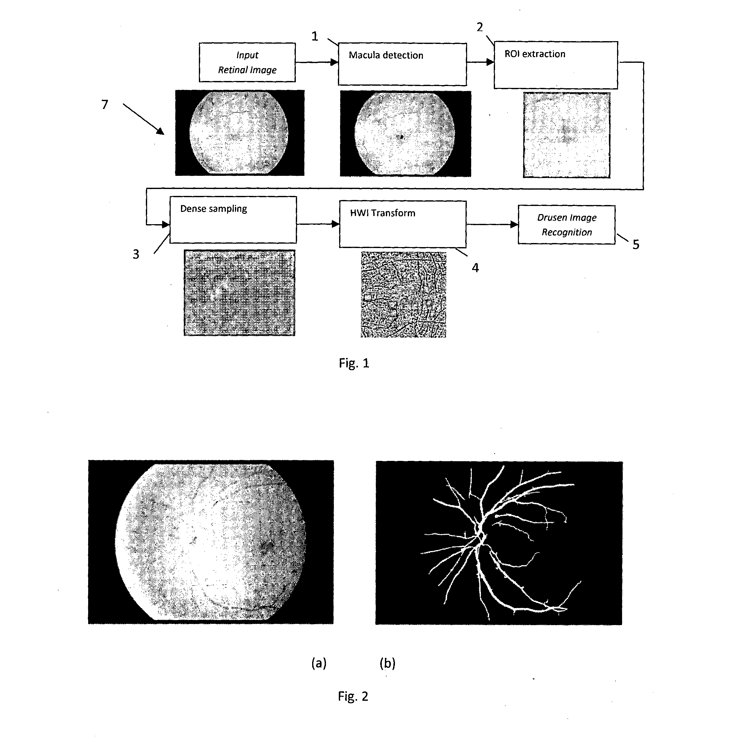 Drusen lesion image detection system