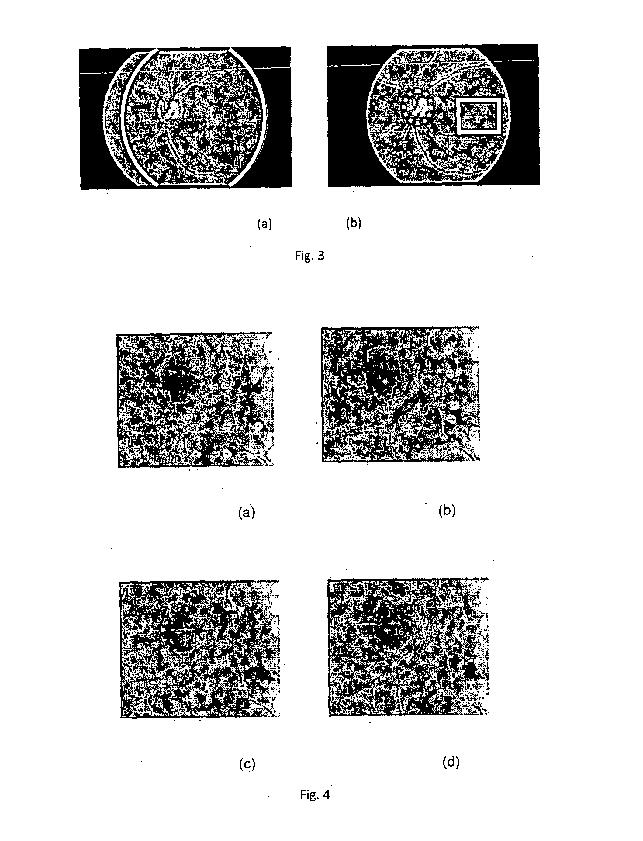 Drusen lesion image detection system