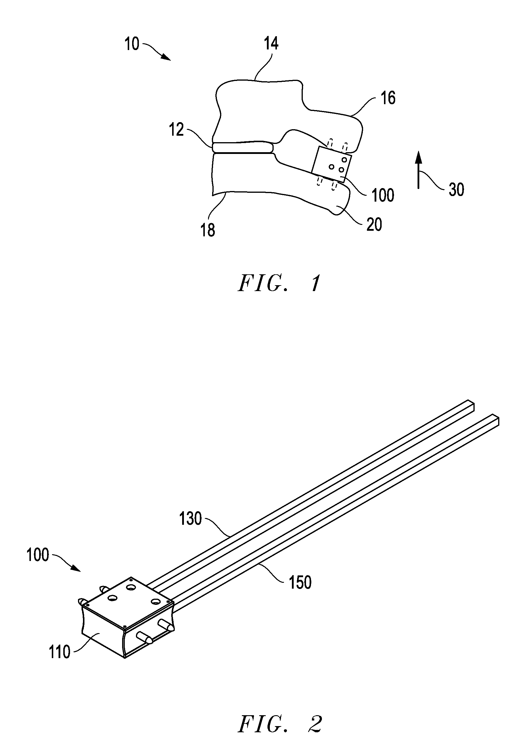 Interlaminar Fixation Device