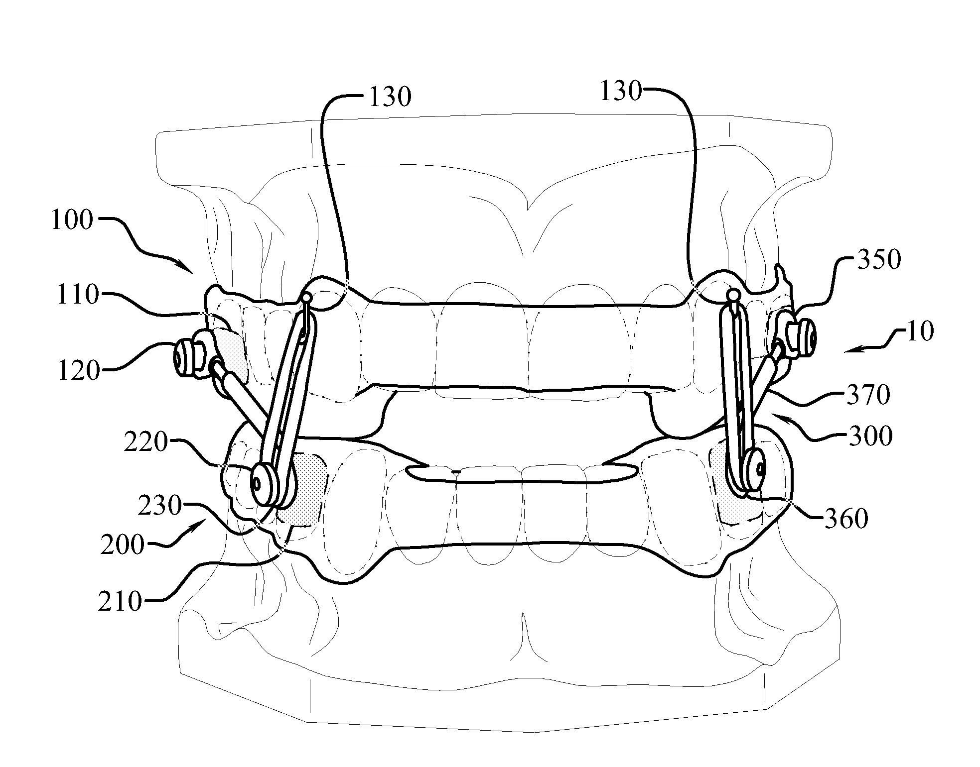 Anti-obstructive airway dental orthotic