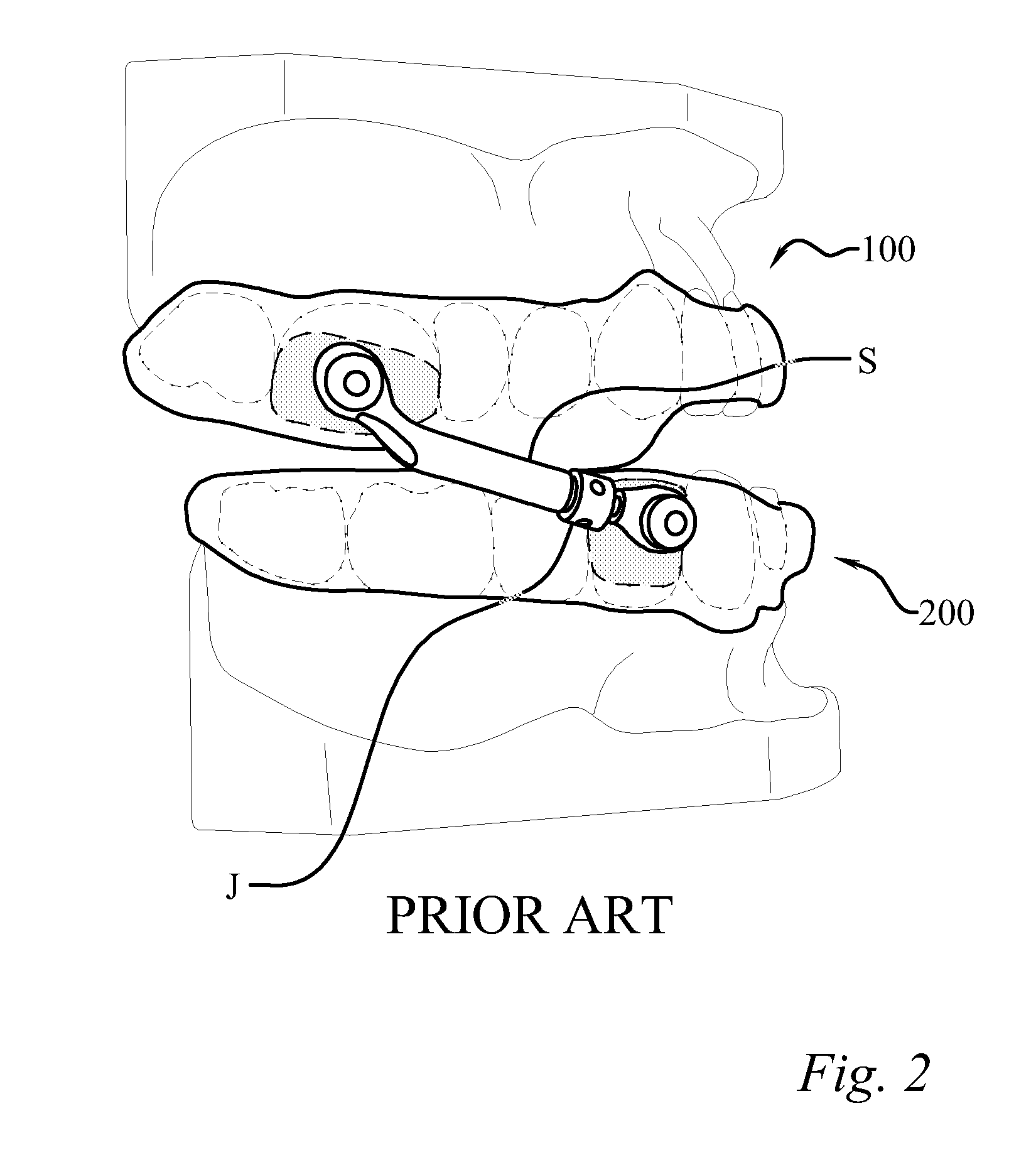 Anti-obstructive airway dental orthotic