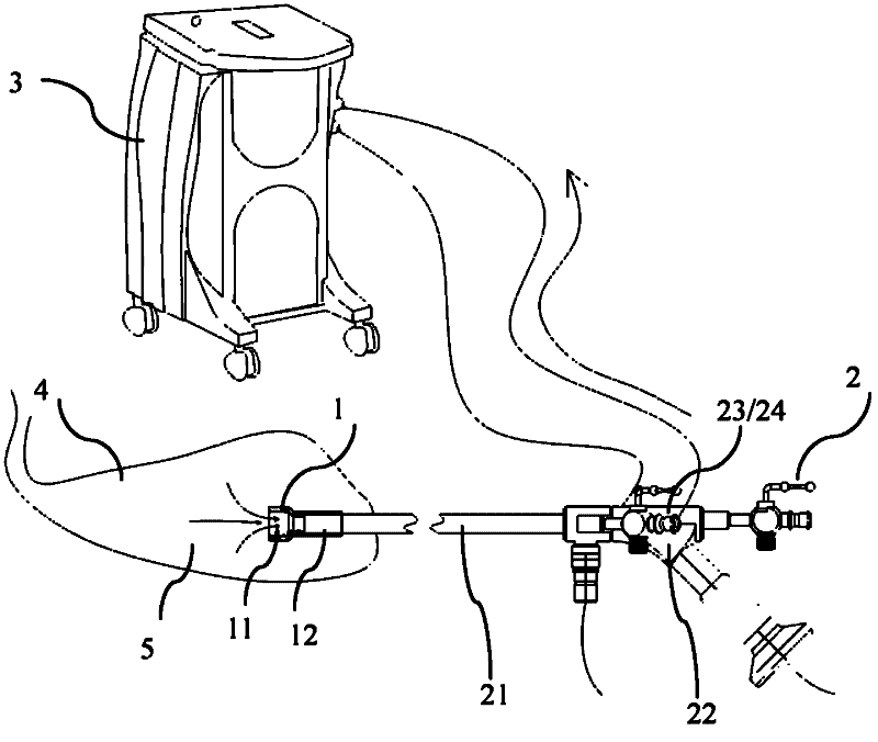 Sand-like gall bladder calculus suction system