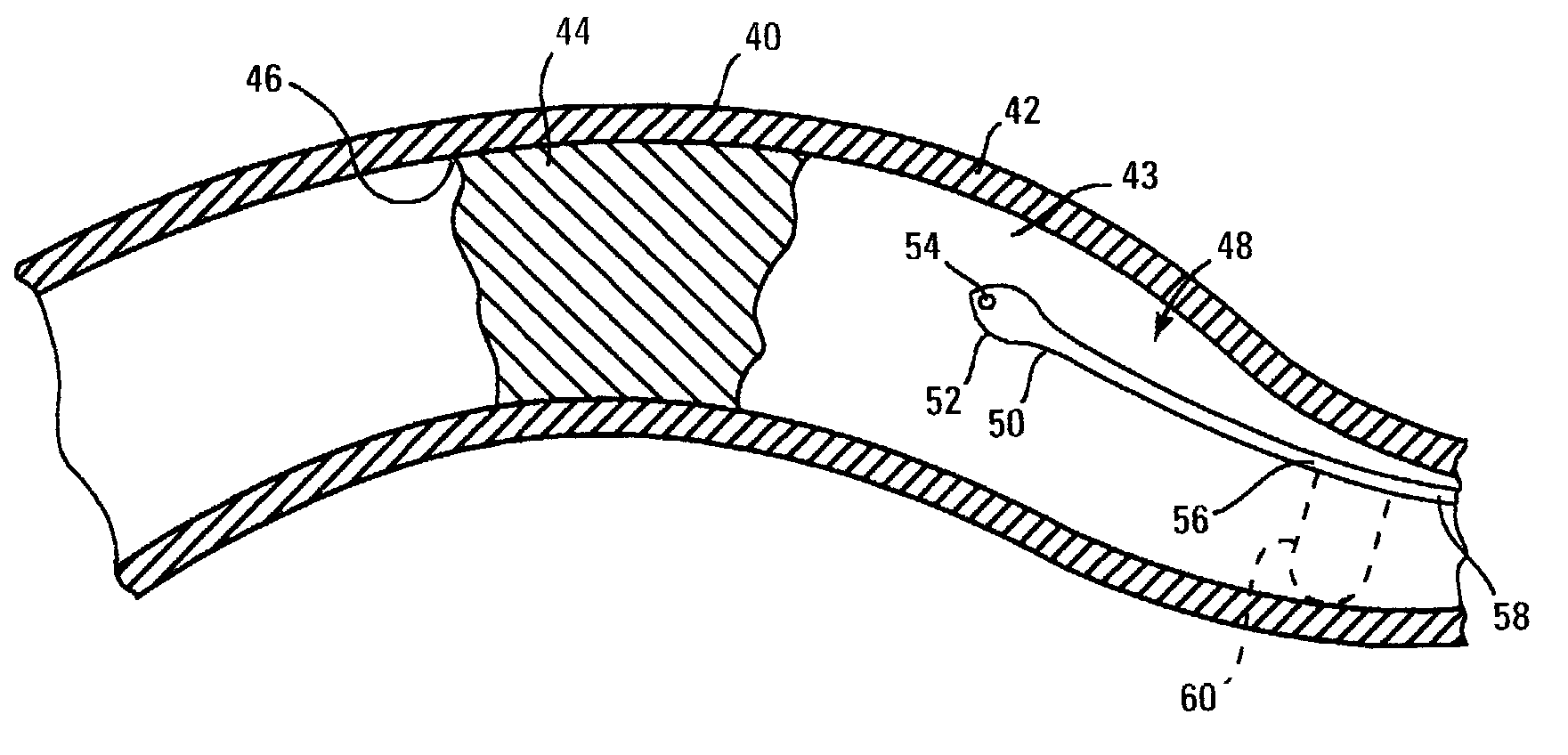 Percutaneous transluminal endarterectomy