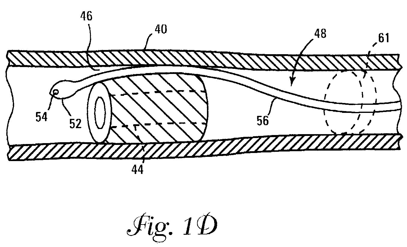 Percutaneous transluminal endarterectomy