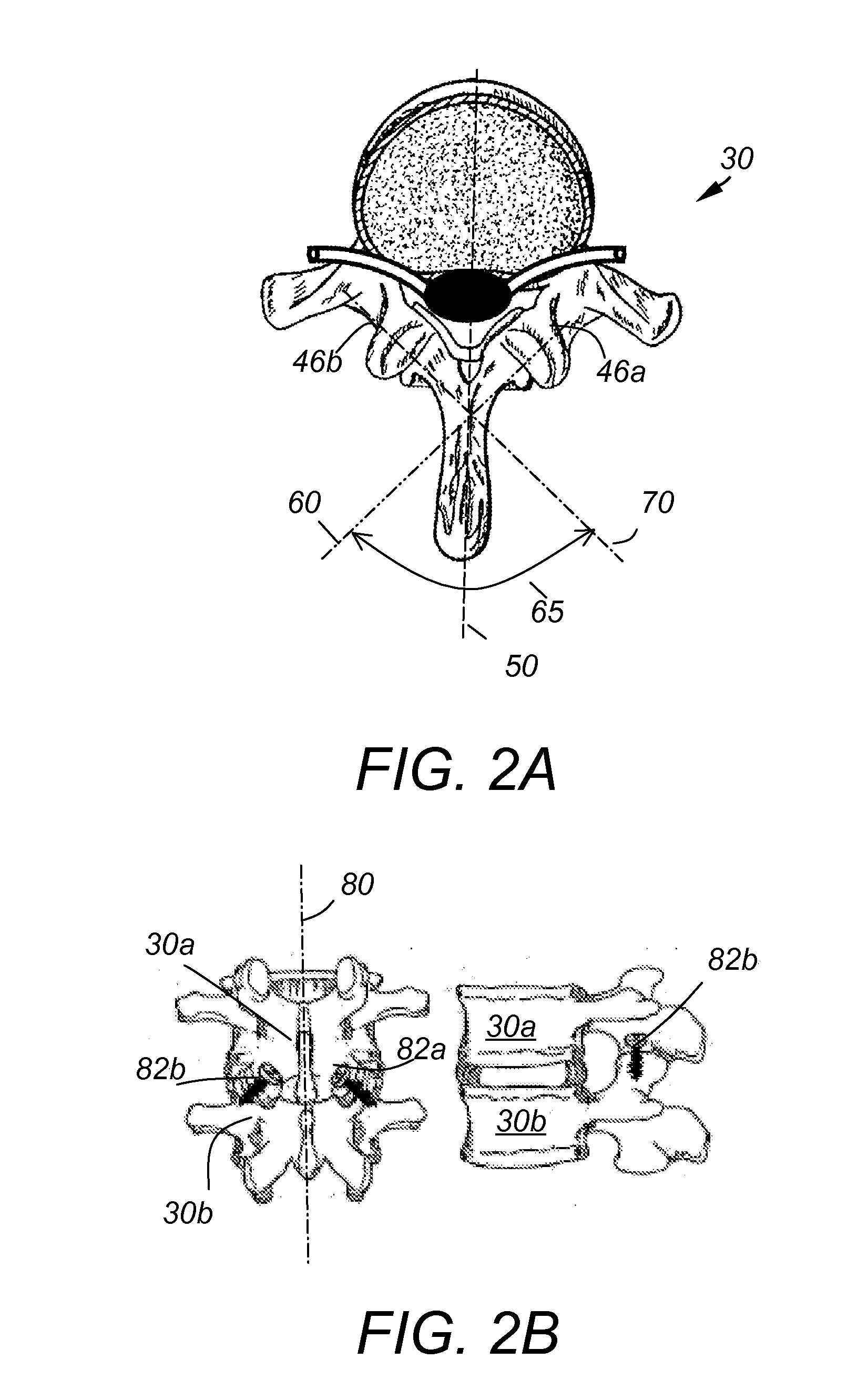 Guidance system,tools and devices for spinal fixation