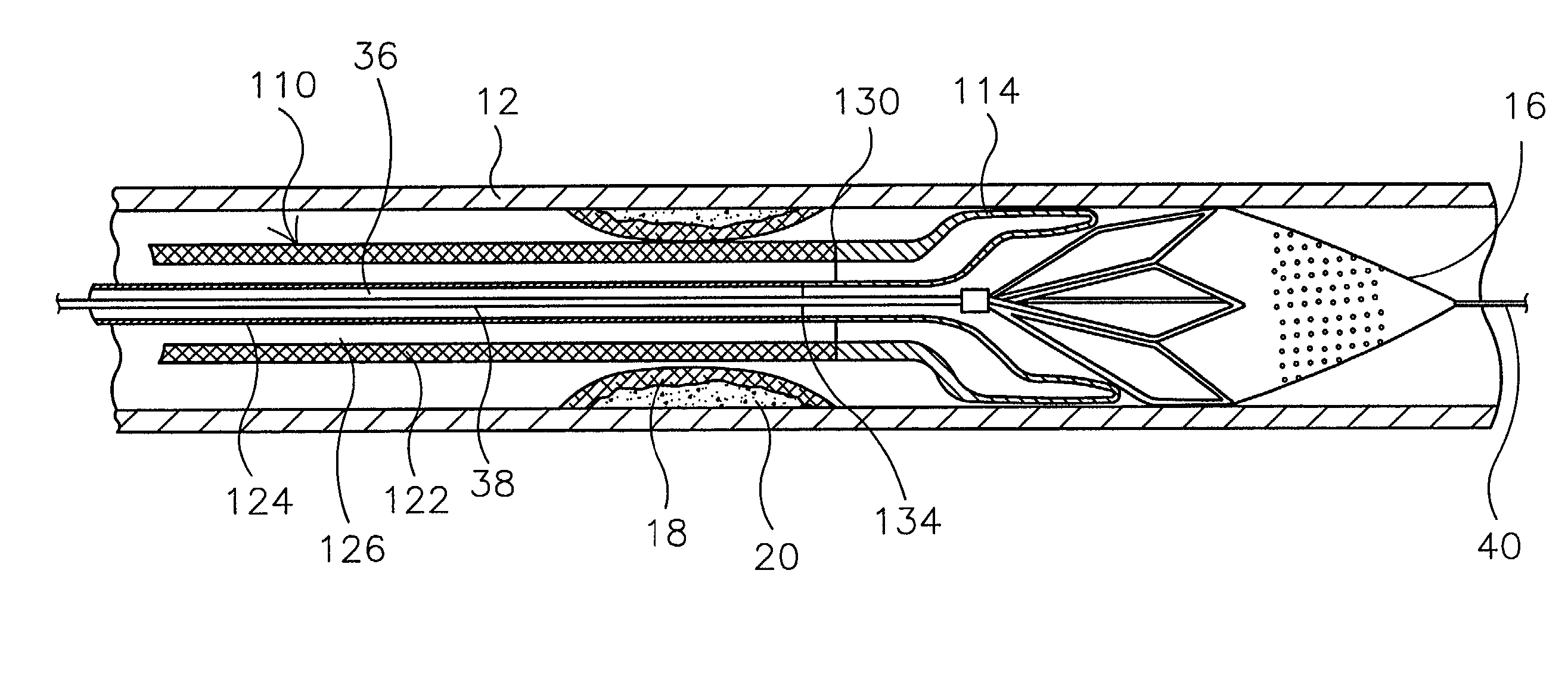 Hydraulic controlled retractable tip filter retrieval catheter