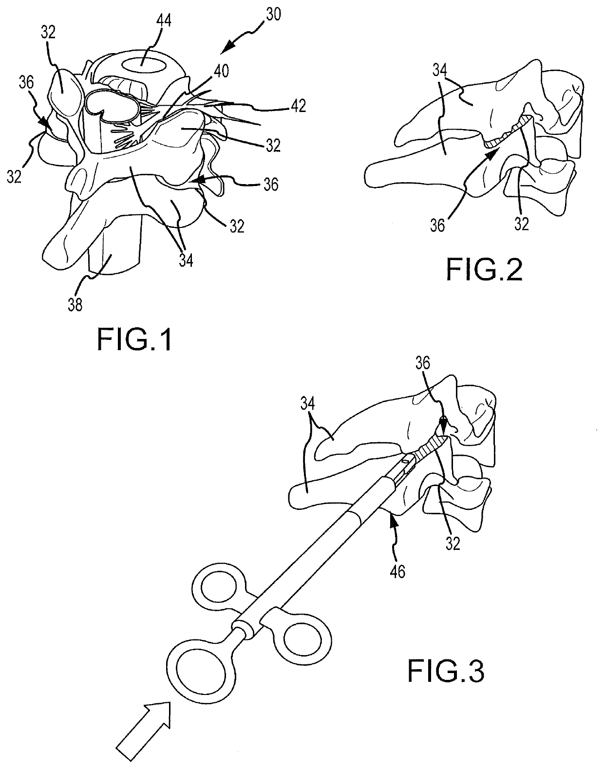 Cervical distraction/implant delivery device