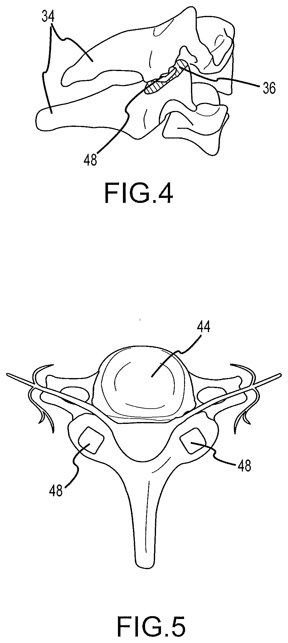 Cervical distraction/implant delivery device