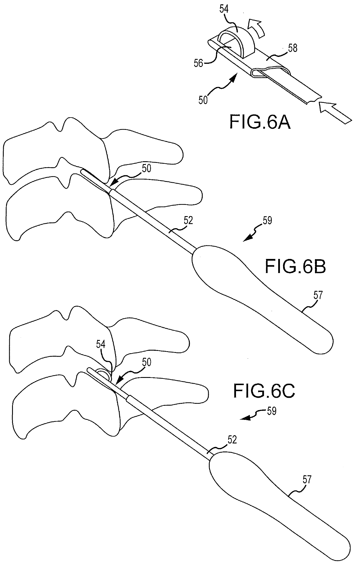 Cervical distraction/implant delivery device