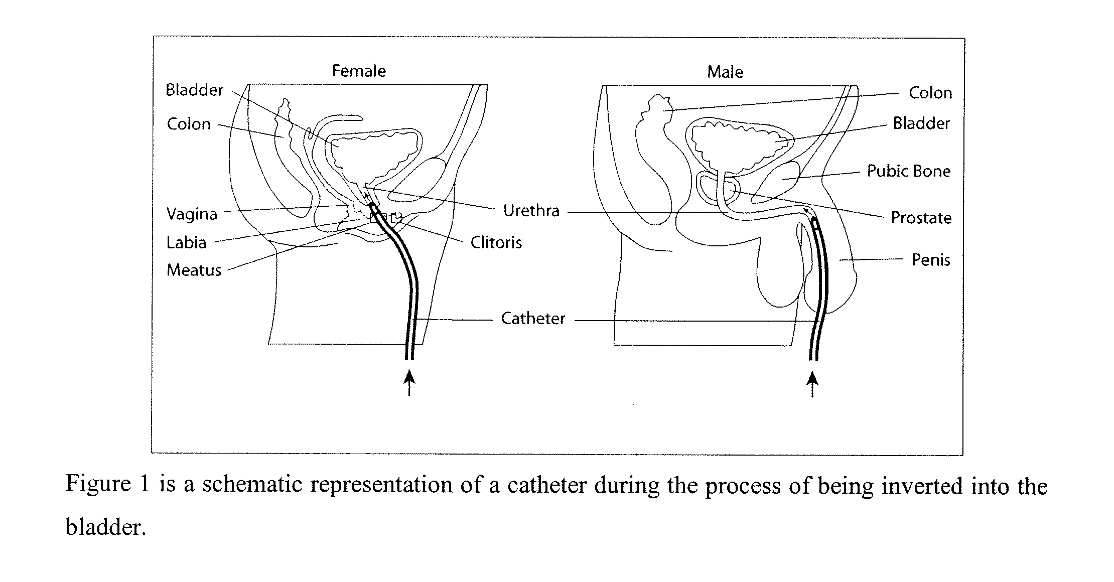 System and method for the prevention of bacterial and fungal infections including Urinary Tract Infections (UTI) using N-halogenated amino acids