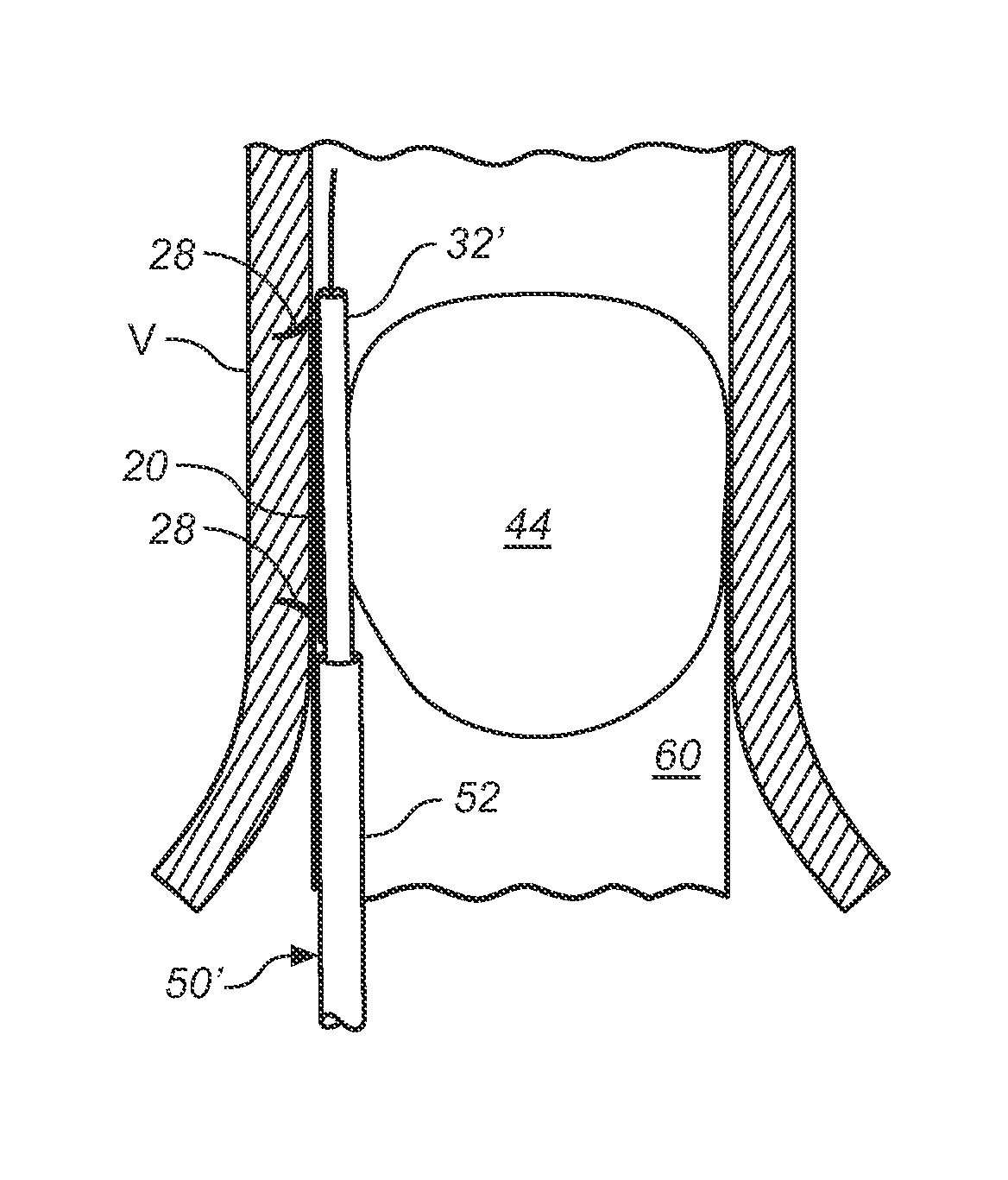 Prosthesis Fixation Apparatus and Methods