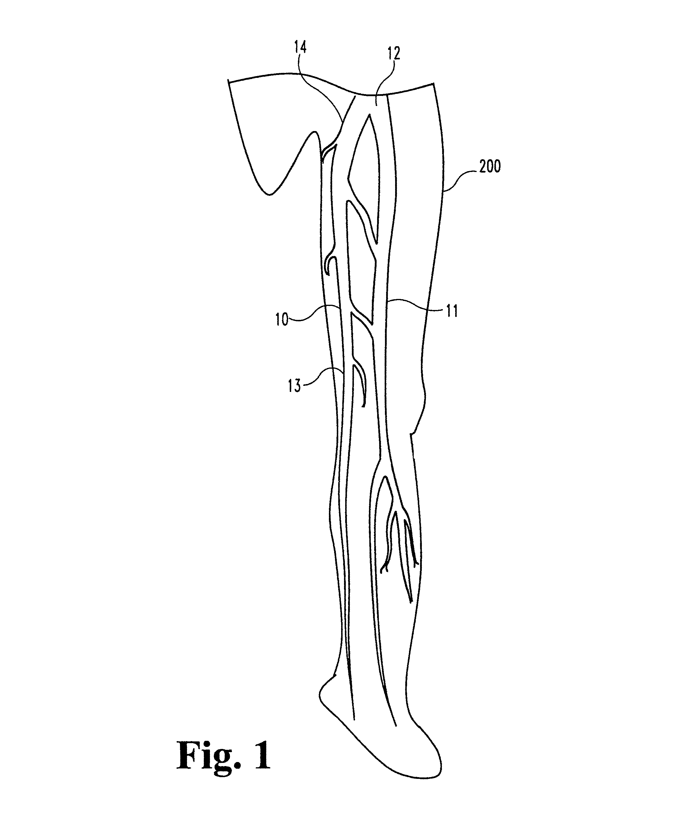 Vascular occlusion methods, systems and devices