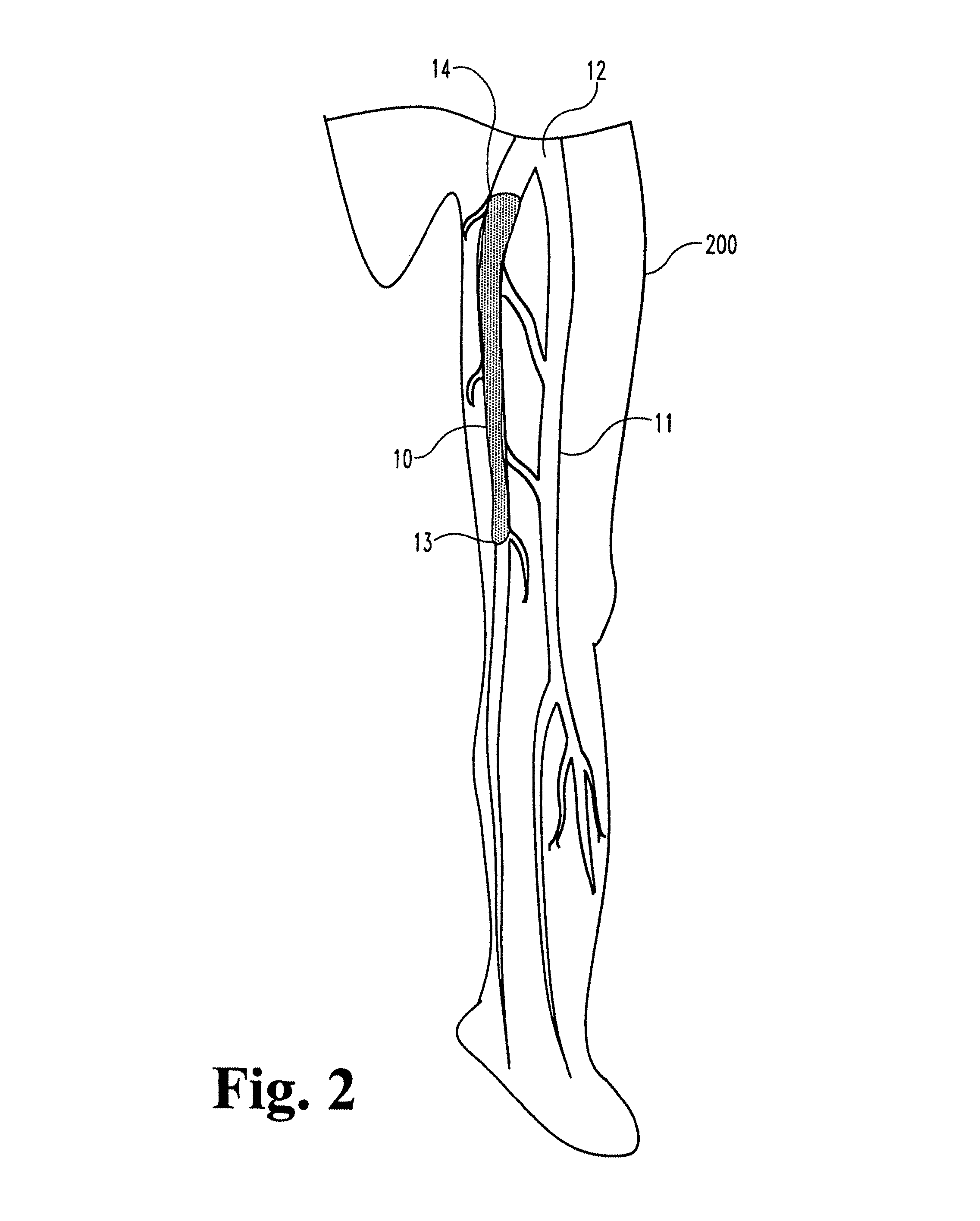 Vascular occlusion methods, systems and devices