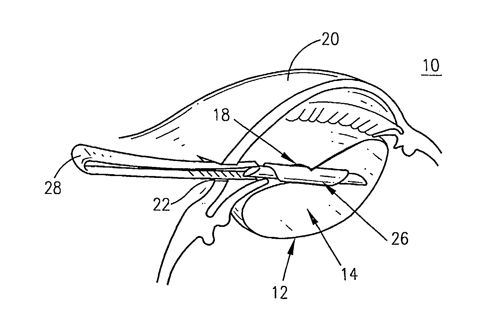 Supplementary endo-capsular lens and method of implantation