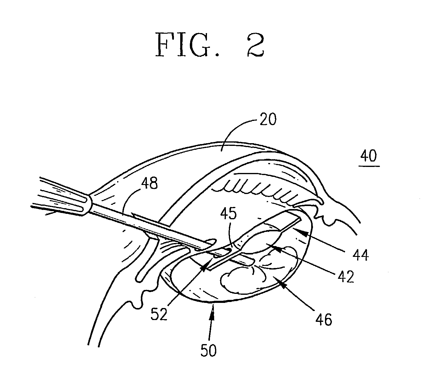 Supplementary endo-capsular lens and method of implantation