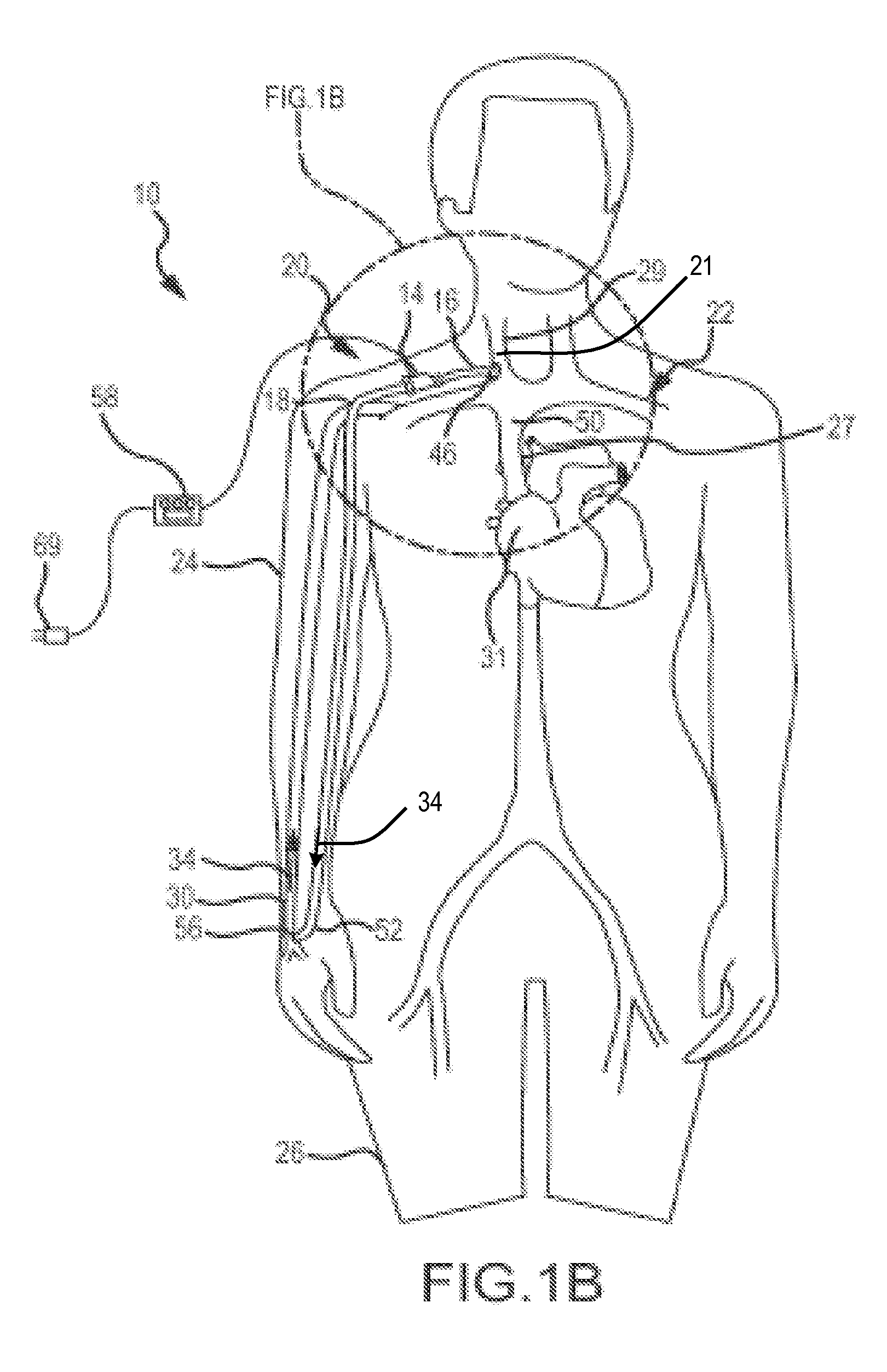 System and method to increase the overall diameter of veins