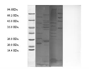 Preparation method and medical application of cervical carcinoma associated trichina antigen antibody