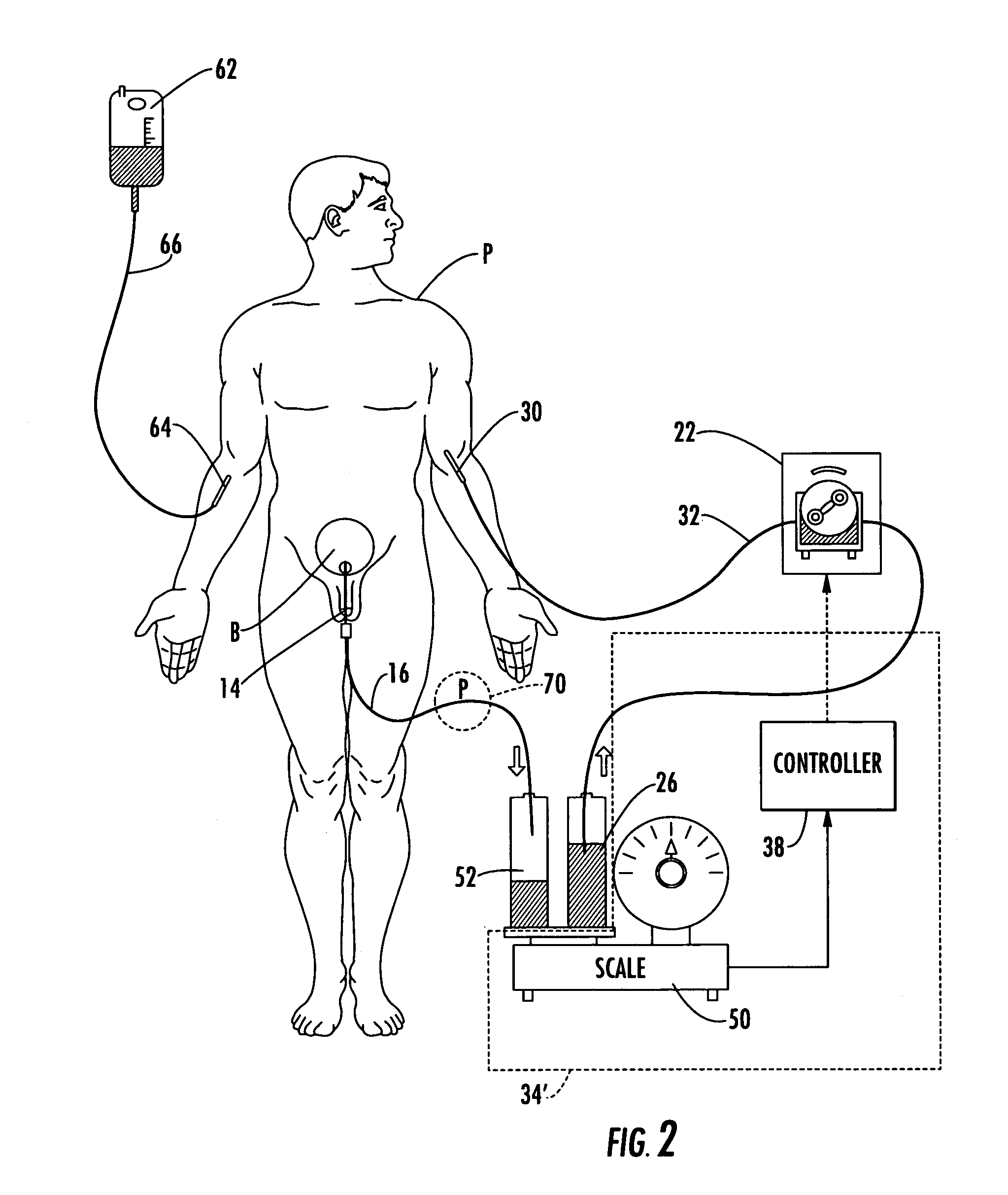 Patient hydration system with a redundant monitoring of hydration fluid infusion