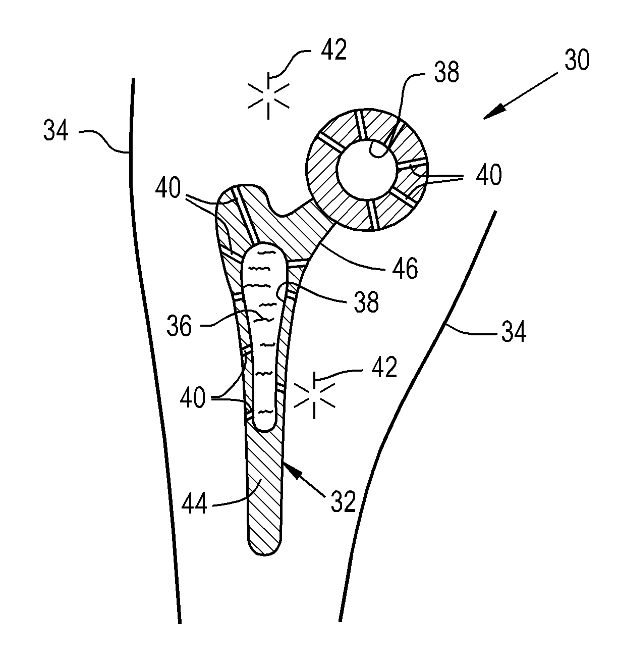 Drug delivery implants