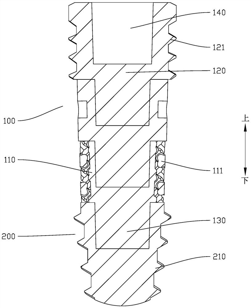 Modularized layered dental implant