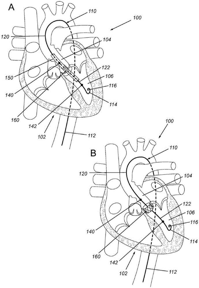 Transcatheter aortic valve implantation pressure wires and uses thereof