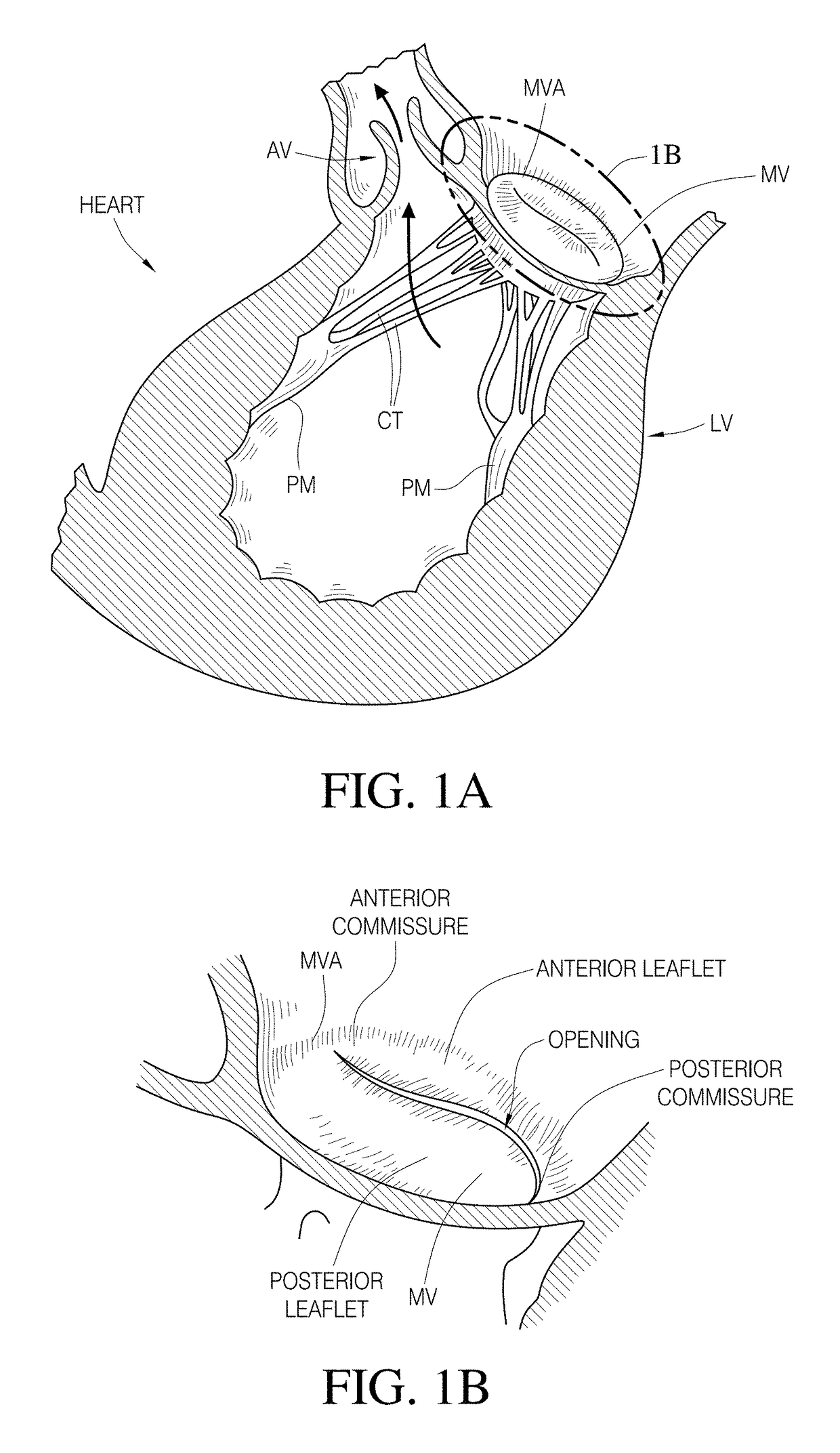 Valve replacement using rotational anchors