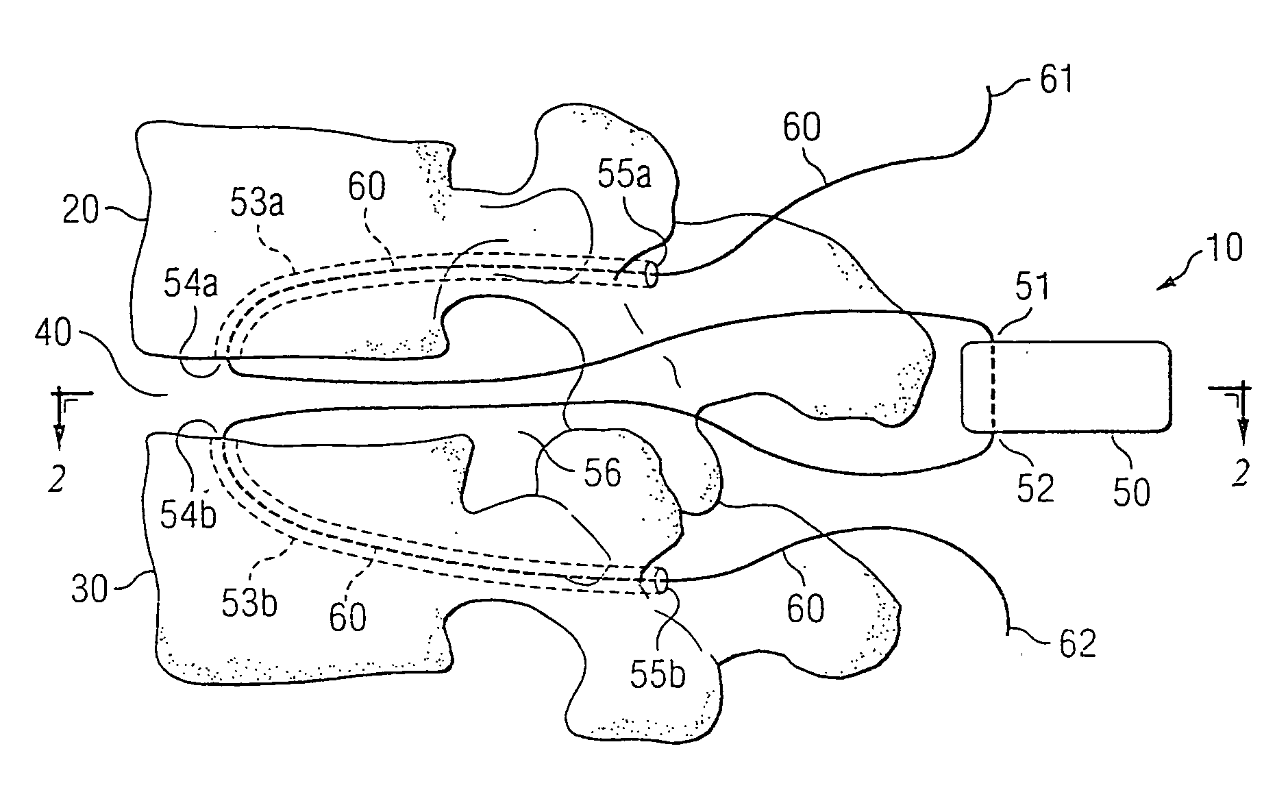 Nucleus replacement securing device and method