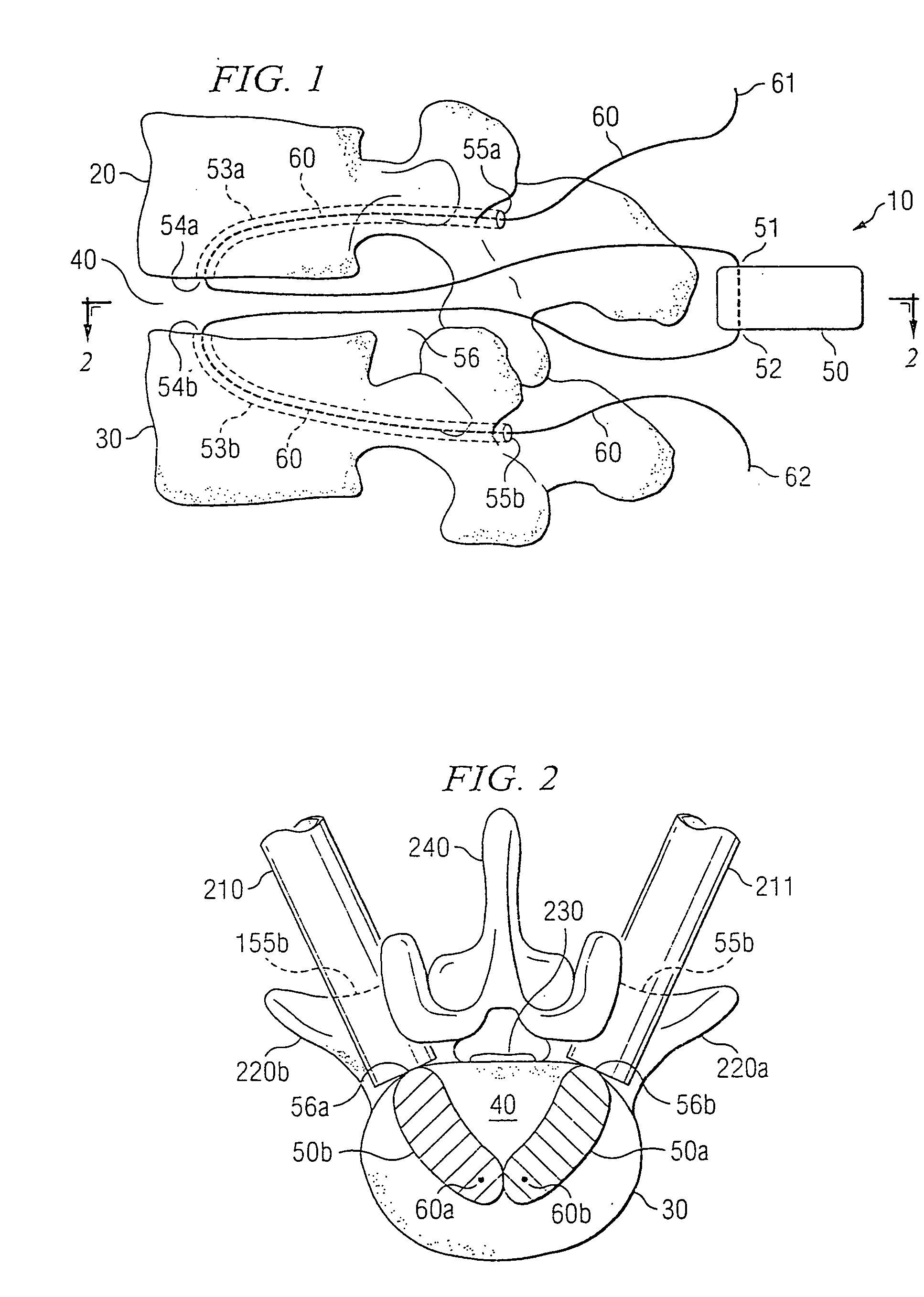 Nucleus replacement securing device and method