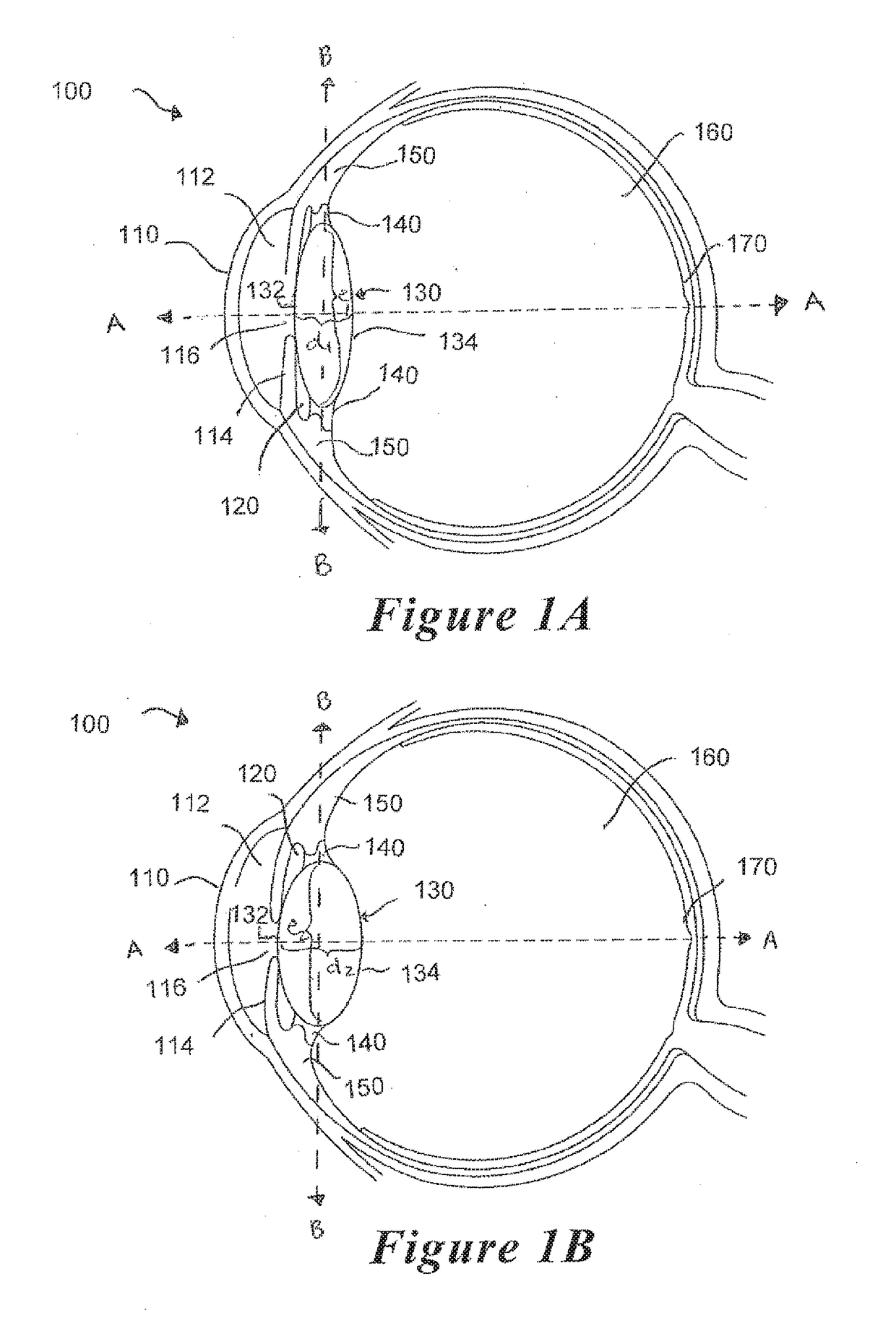 Accommodating intraocular lens