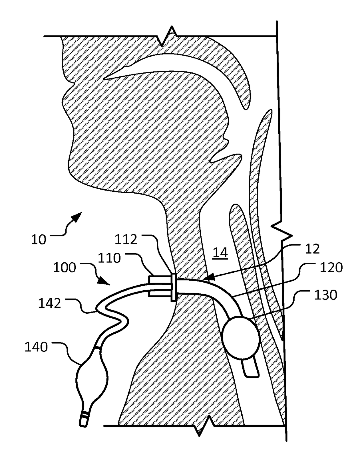 Double cuff tracheostomy device